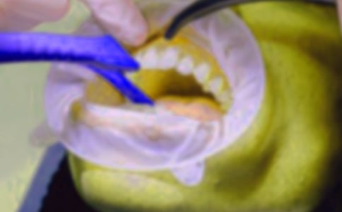 小学五年级作文:拔牙记